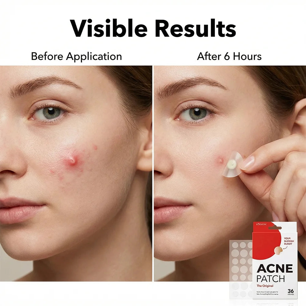 Invisible Acne Pimple Patches (36 Pack)